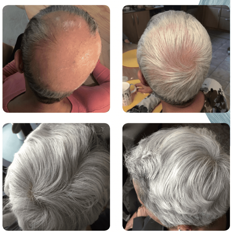 Behandling av håravfall före och efter